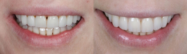 Before and after: Veneers