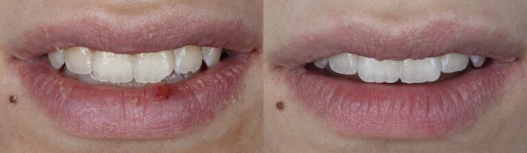 Before and after: Broken Corner Incisor