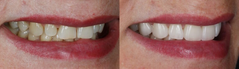 Before and after: Porcelain Veneers