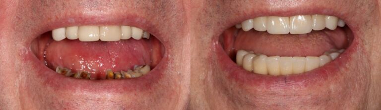 Before and after: Full Ceramic Bridges