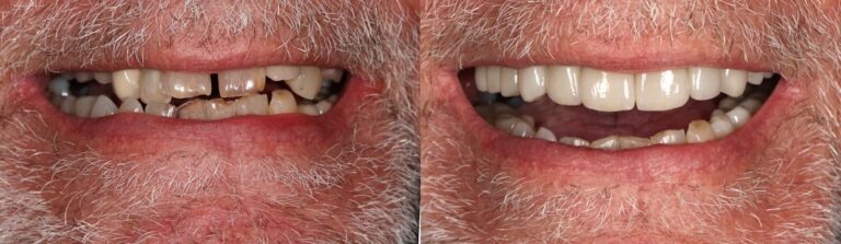 Before and after: Crowns & Bridges