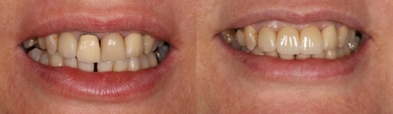 Before and after: Immediate implant to replace a broken tooth