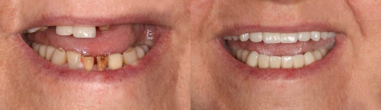 Before and after: Bridges