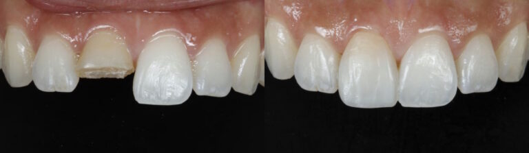 Before and after: Broken Central Incisor