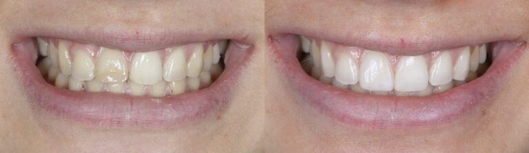 Before and after: Composite Veneers