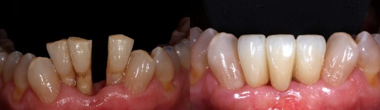 Before and after: Immediate implant to replace front teeth