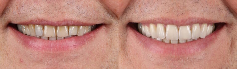 Before and after: Porcelain Veneers