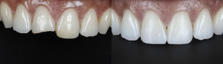 Before and after: Broken Incisors