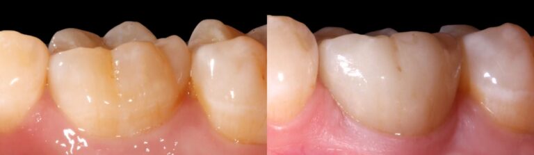 Before and after: Immediate Implants