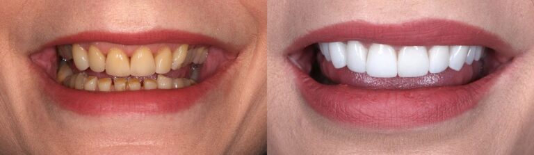 Before and after: Immediate implant to replace a baby tooth