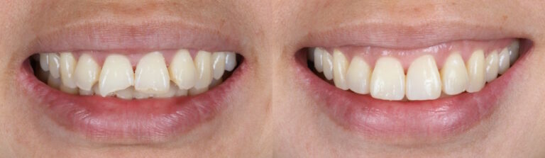 Before and after: Broken 3 Incisors