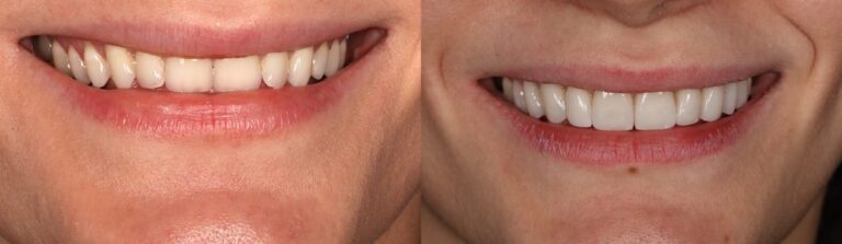 Before and after: Smile Makeover