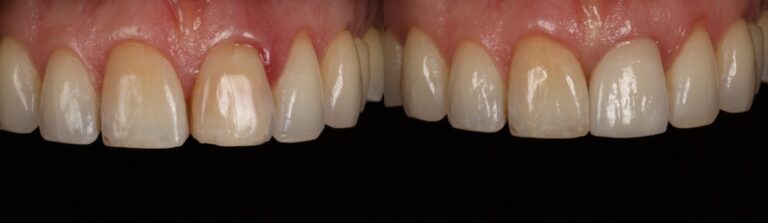 Before and after: Immediate implant for a front tooth
