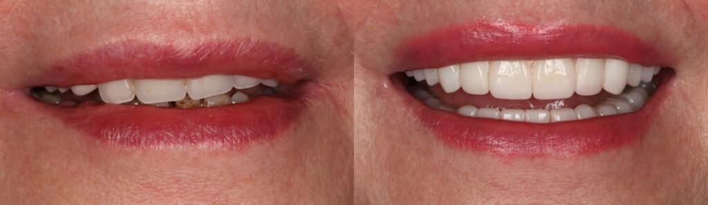 Beforeafter 4