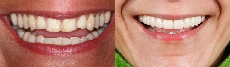 Before and after: Smile Makeover