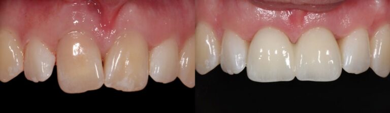Before and after: Extraction, immediate implant and bone augmentation