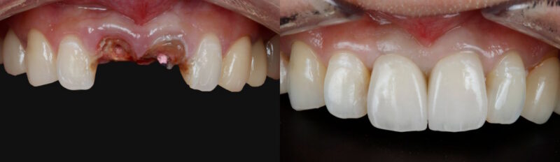 Lost Front Crowns before and after
