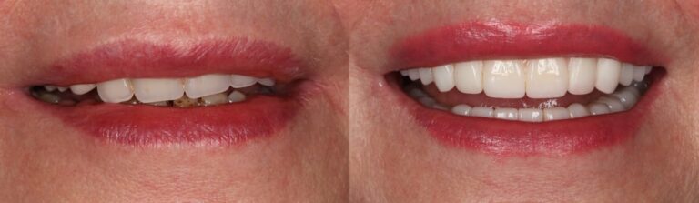 Before and after: Upper Jaw All-on-4