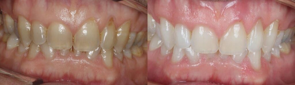 Before and after: Teeth Whitening