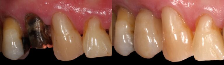 Before and after: Extraction, immediate implant and temporary