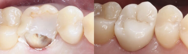 Before and after: Broken Molar
