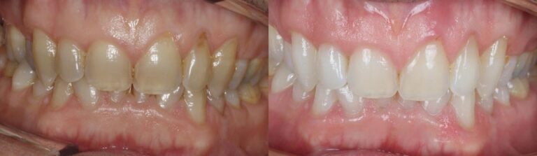 Before and after: Teeth Whitening