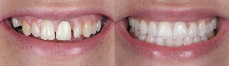 Before and after: Porcelain Veneers