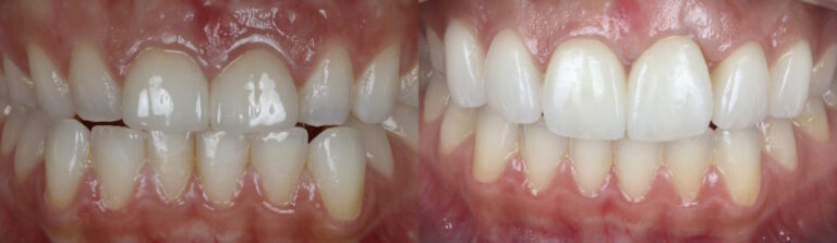Before and after: Porcelain Veneers