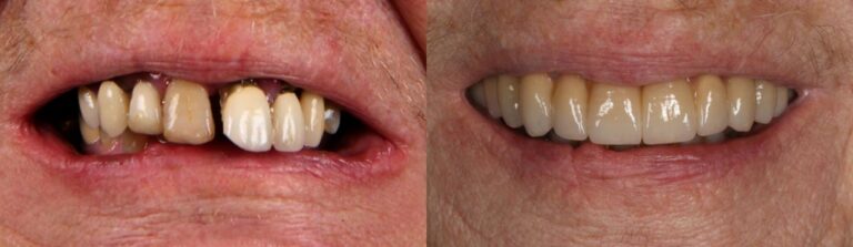 Before and after: Root Canal Treatments, extractions & full ceramic bridge