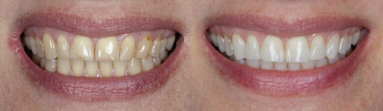 Before and after: Composite Veneers