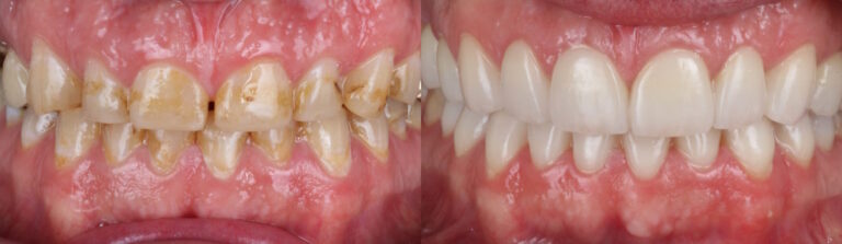 Before and after: Porcelain Veneers