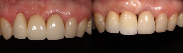 Before and after: Immediate implant to replace front teeth