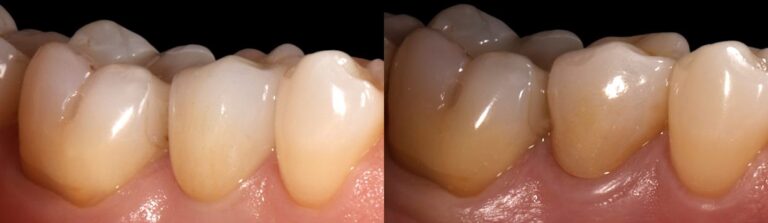 Before and after: Immediate implant to replace front teeth