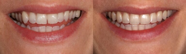 Before and after: Invisalign/Composite Bonding