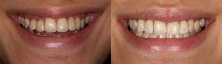 Before and after: Implant bridge & full ceramic bridge to replace front teeth