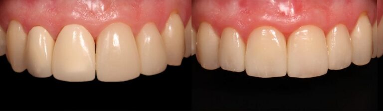Before and after: Aesthetic treatment with veneers