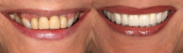 Before and after: Bridges
