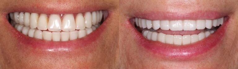 Before and after: Upper Jaw All-on-6 Dental Implants