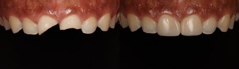 Before and after: Composite Fillings