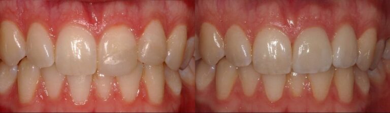Before and after: Aesthetic treatment with veneers