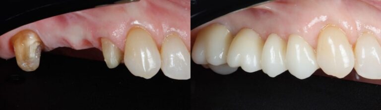 Before and after: 4 unit zirconia bridge