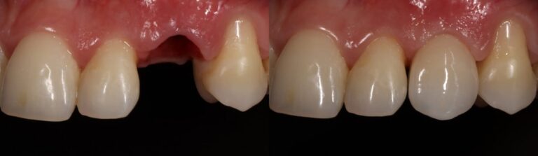 Before and after: Immediate Implants
