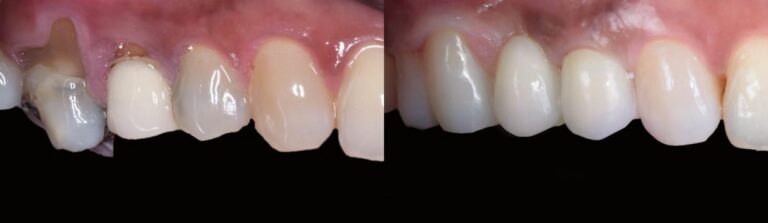 Before and after: Dental bridge