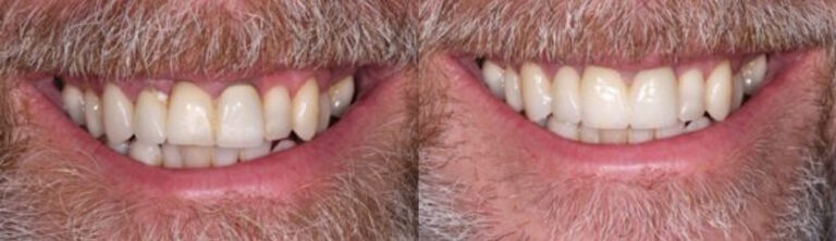Before and after: Bridges