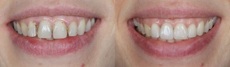 Before and after: Composite bonding to replace failing restorations