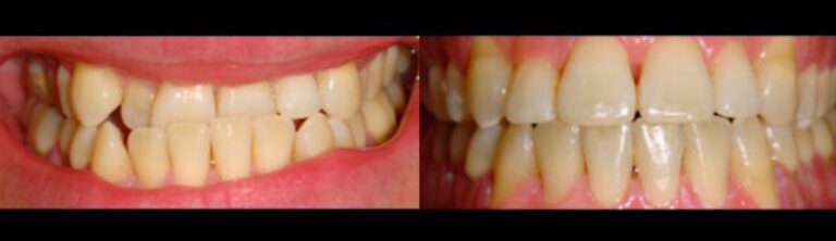 Before and after: Ceramic Braces