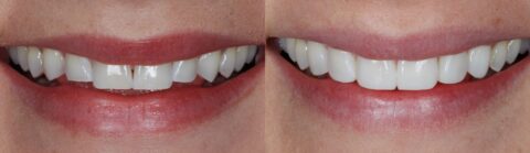 Composite bonding to reverse tooth wear