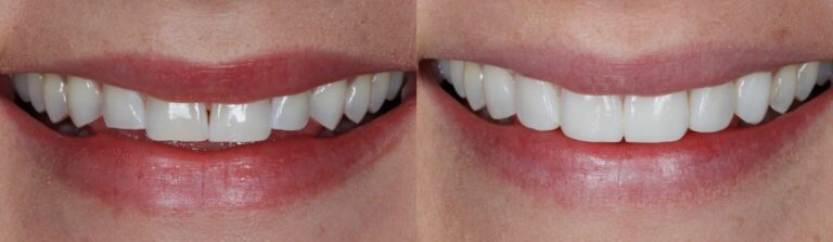 Before and after: Composite bonding to reverse tooth wear