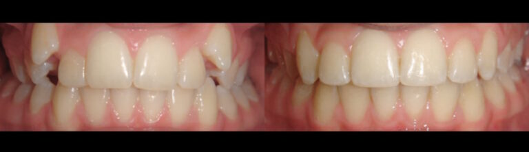 Before and after: Corrective Braces