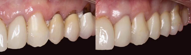 Before and after: Zirconia Crown